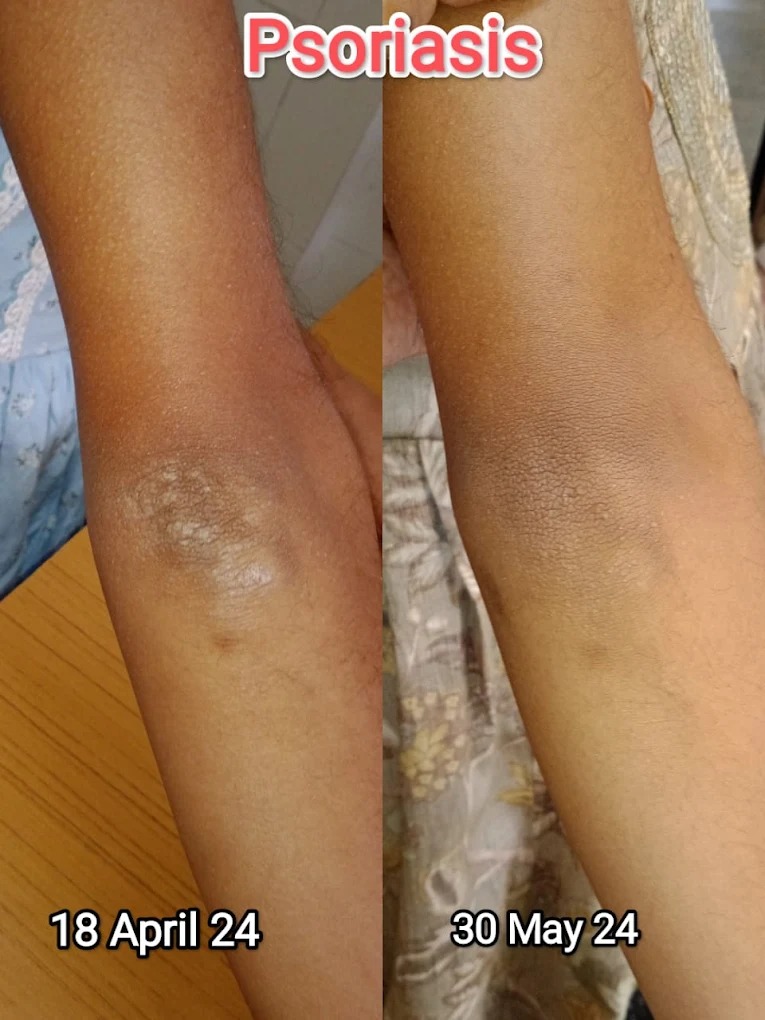 Arm Psoriasis Healing